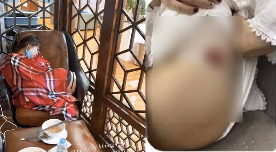 Hòa Minzy kiệt sức, tiêm 15 mũi thuốc/tuần 