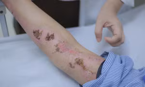 Cô gái gục xuống giữa cánh đồng sau cú sét đánh