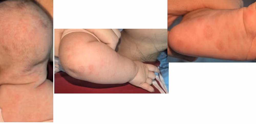Nhiều trẻ mắc giang mai bẩm sinh vì mẹ bỏ lỡ xét nghiệm quan trọng