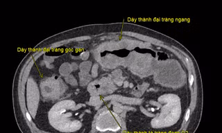 Ca đại phẫu kéo dài hơn 8 giờ giải cứu bệnh nhân mắc ung thư kép