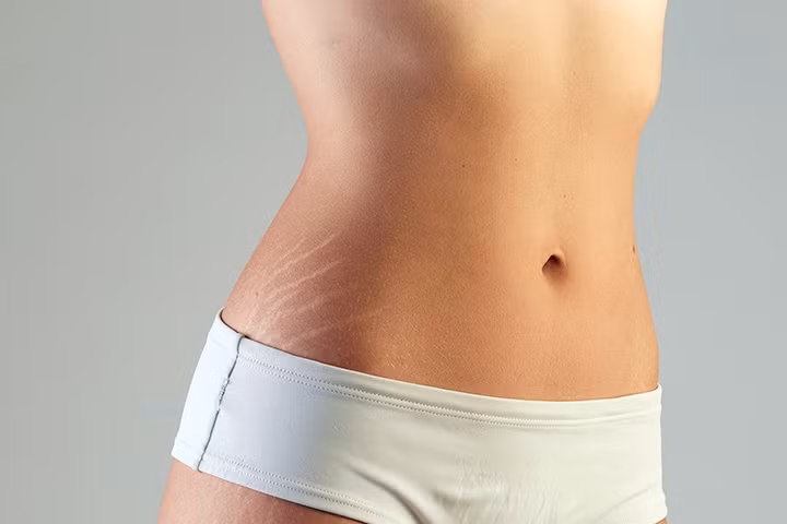 Rạn da tuổi dậy thì: Rắc rối ngoại hình khó nói thành lời của con gái ảnh 1