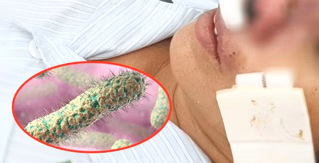9 bệnh nhân mắc bệnh ‘vi khuẩn ăn thịt người’ Whitmore ảnh 1