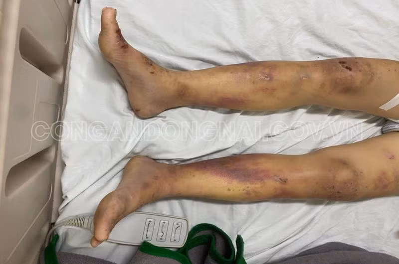 Chuỗi ngày kinh hoàng trong quán cà phê kích dục của nữ tiếp viên bị đánh thương tật 96% ảnh 2 Chuỗi ngày kinh hoàng trong quán cà phê kích dục của nữ tiếp viên bị đánh thương tật 96% ảnh 2