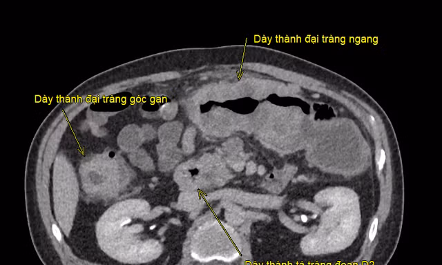 Ca đại phẫu kéo dài hơn 8 giờ giải cứu bệnh nhân mắc ung thư kép