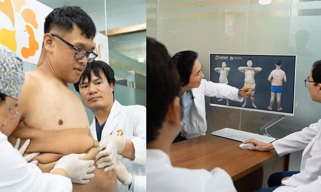 Trọng Nhân trải qua ca phẫu thuật cắt da lần thứ 3 với miếng da khổng lồ 8.1kg