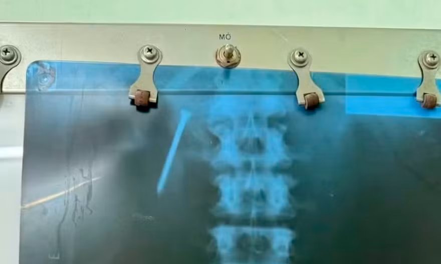 Người đàn ông bất cẩn nuốt phải đinh dài 5 cm 