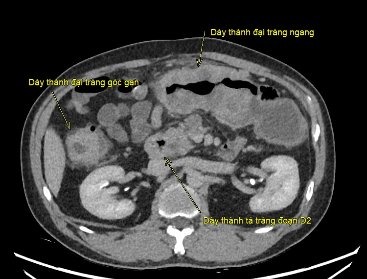 Ca đại phẫu kéo dài hơn 8 giờ giải cứu bệnh nhân mắc ung thư kép