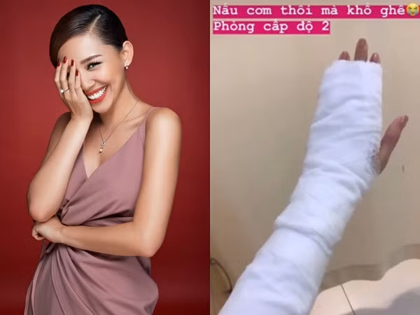 Các fan lo lắng khi Tóc Tiên phải băng bó vì bị phỏng cấp độ 2