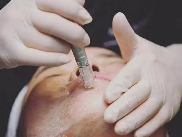 Cấy phấn - cẩn trọng nếu không muốn thành... mèo khoang