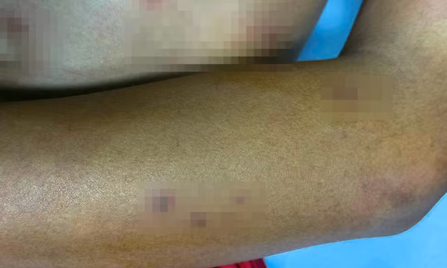 Thiếu niên 14 tuổi ở Cà Mau bị ong vò vẽ đốt 55 vết, nguy kịch