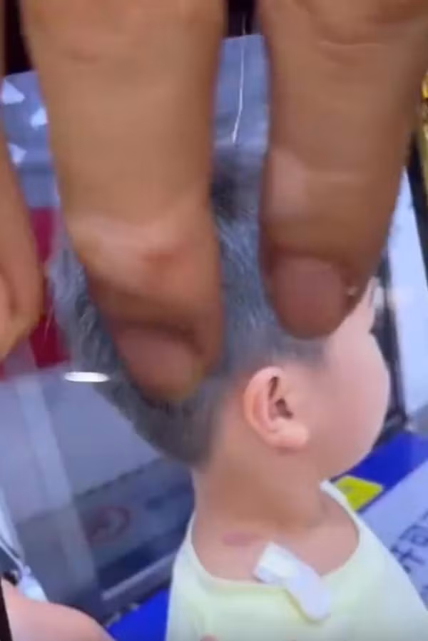 Bé trai bị bầm ở cổ